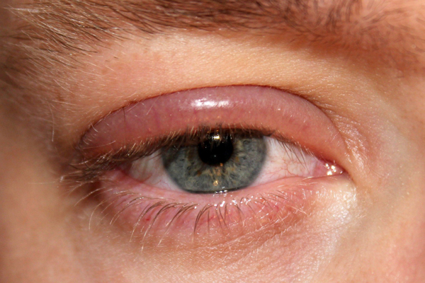 التهاب پلک چشم یا بلفاریت چیست؟