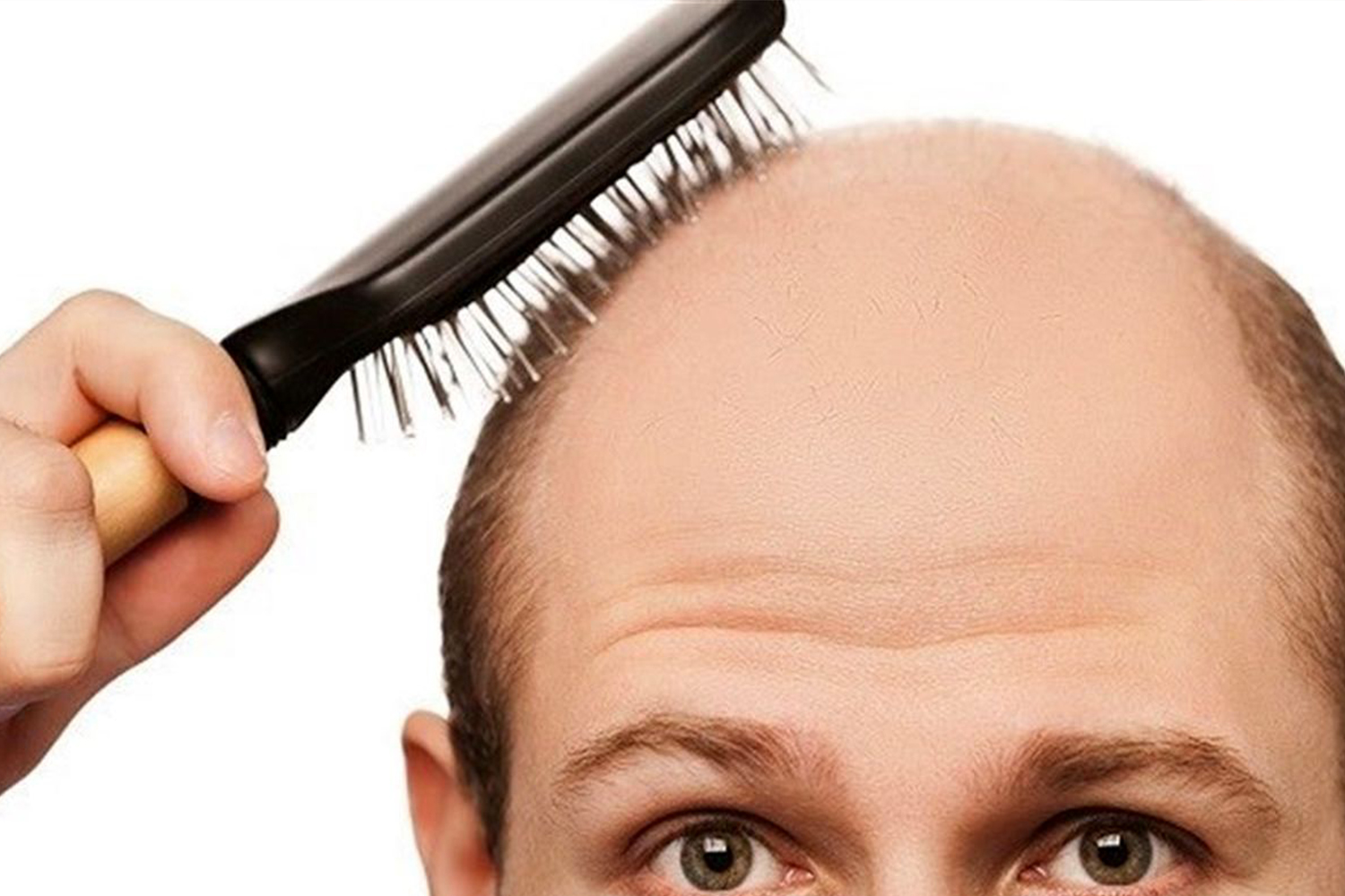 درباره‌ی عمل کاشت مو بیشتر بدانیم