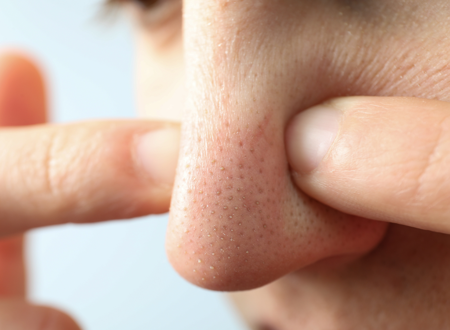 روش های از بین بردن جوش سرسیاه بینی و چانه
