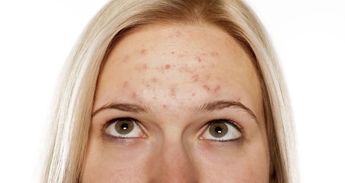 علت جوش پیشانی